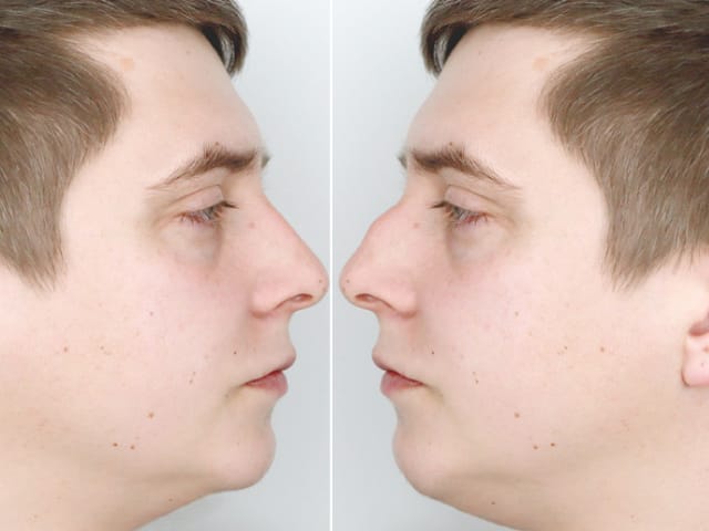 antes y después de rinomodelación en hombre