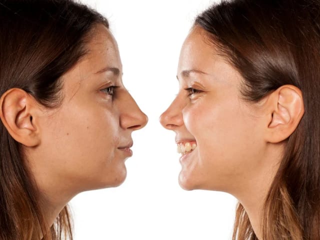 Antes y después rinomodelacion en joven